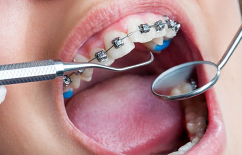 Best Time to Start Orthodontic Treatment