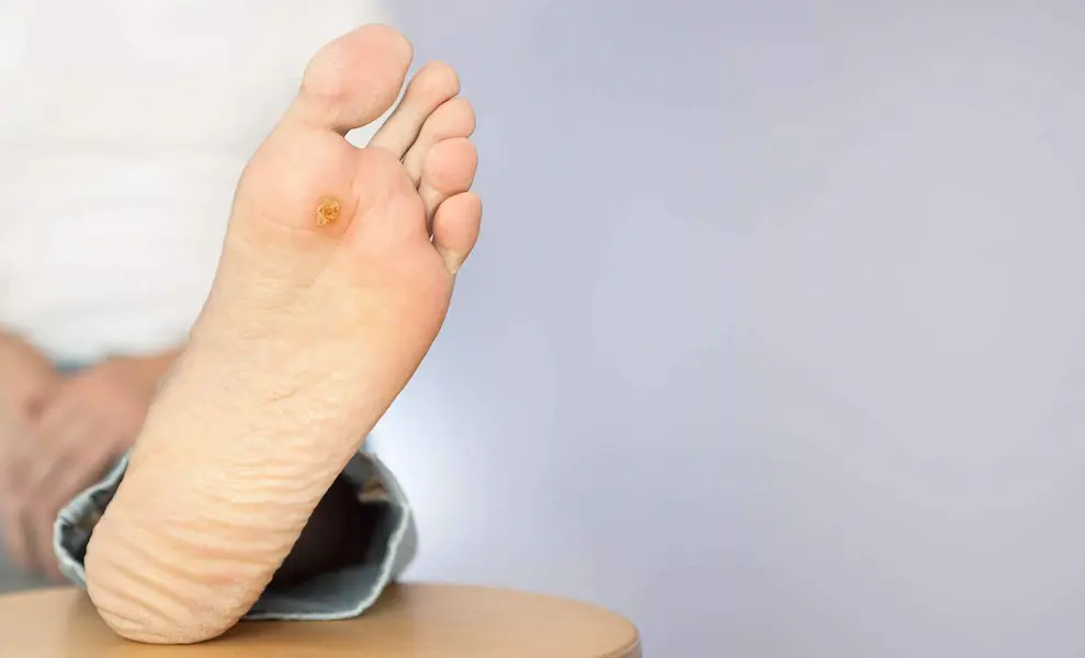 Diabetic Foot Ulcers: The Best T