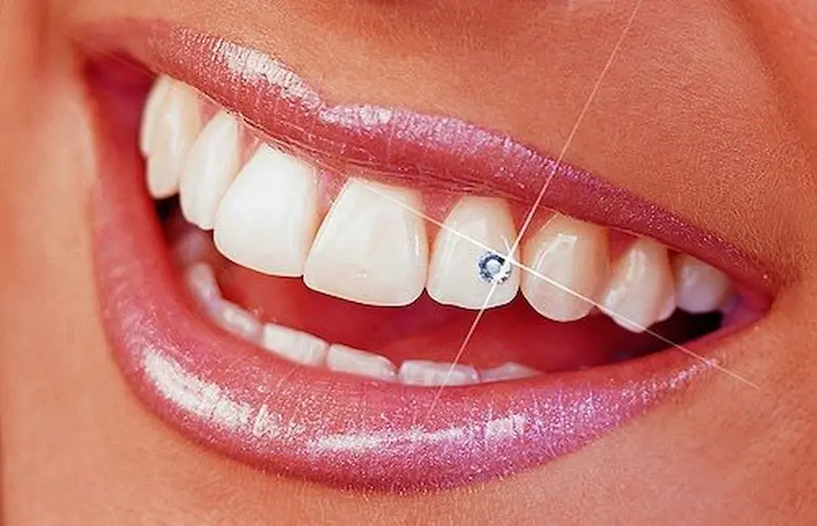 Sparkle with Style: The Complete Guide to Diamond on Tooth Trends